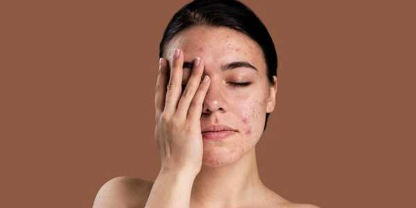 8 Best Skincare Products For Sensitive Eczema-Prone Skin