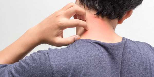 Understanding HIV-Related Rashes: Causes, Symptoms, and Treatment