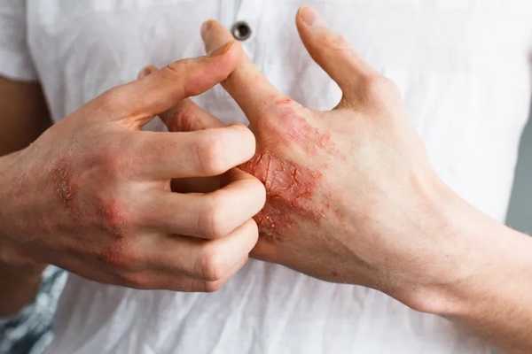 Why Seniors Shouldn’t Ignore These Atopic Dermatitis Signs