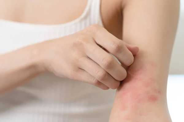 Why Seniors Should Pay Attention to These Atopic Dermatitis Signs