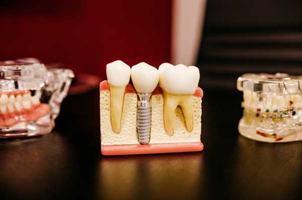 Everything You Need to Know About Screw-Less Dental Implants