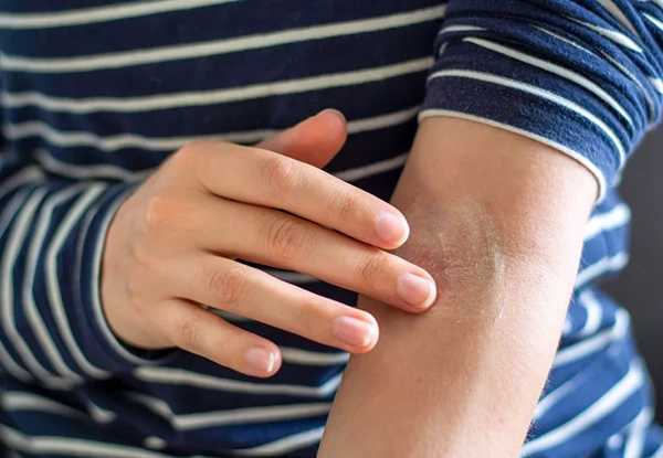 Why Seniors Shouldn't Overlook These Atopic Dermatitis Symptoms