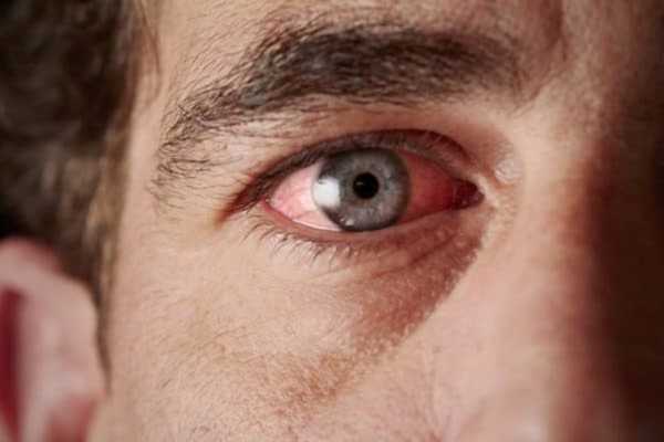 Thyroid Eye Disease (TED): Symptoms, Diagnosis, and Effective Treatment Options