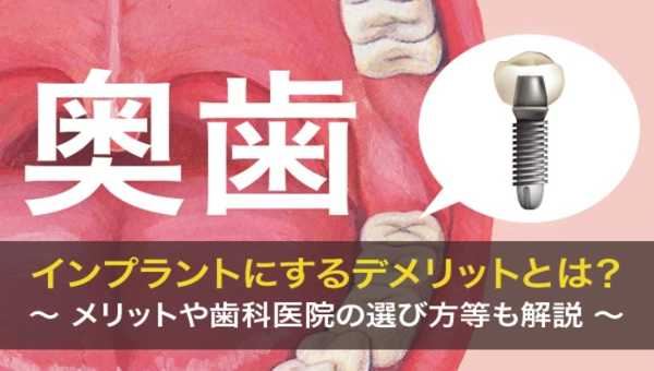 インプラント入れ歯とは？費用・保険・口コミまで徹底解説
