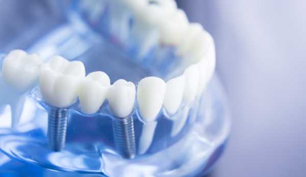 Dental Implants: A Permanent Solution for Missing Teeth